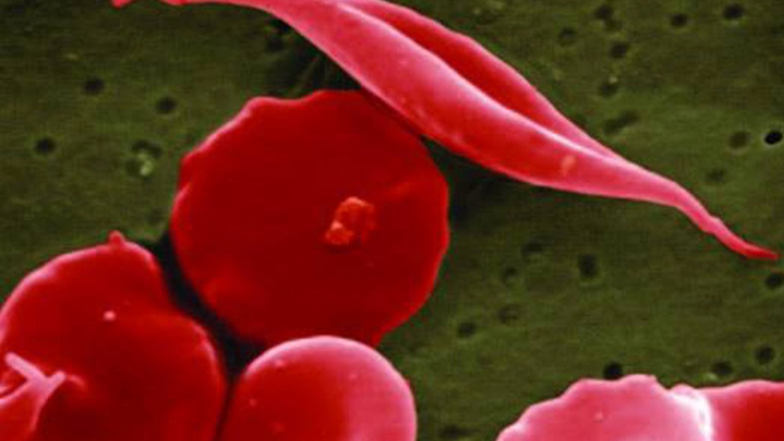 FDA Approves Sickle Cell Treatments, Including 1 Using CRISPR | 11alive.com