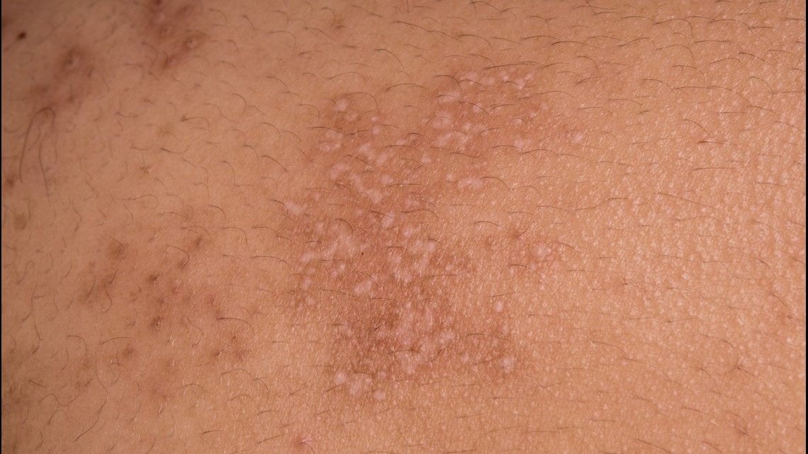 UGA treatment for shingles, chickenpox, herpes - Vimarsana News