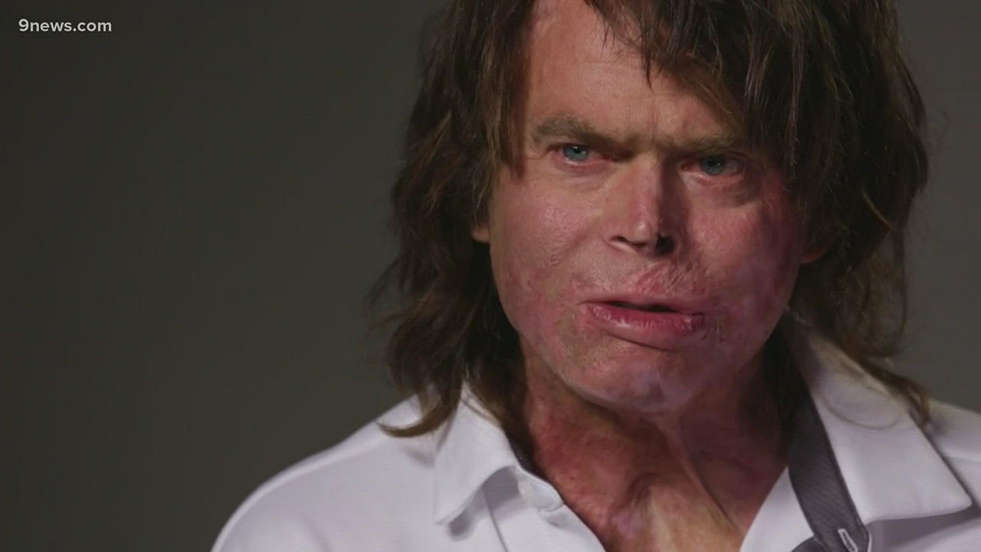 Man makes miraculous recovery after preventable inferno burns 90