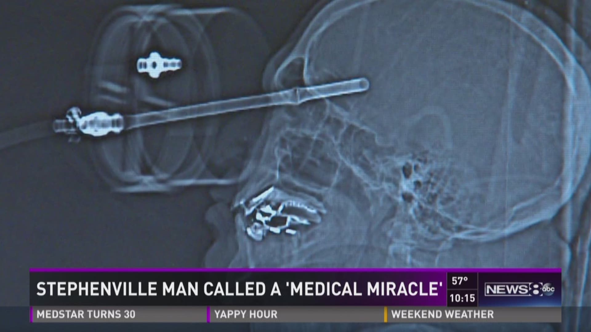 Dale White miraculously survived after a piece of copper tubing punctured his skull and penetrated his brain. Sonia Azad has his story.