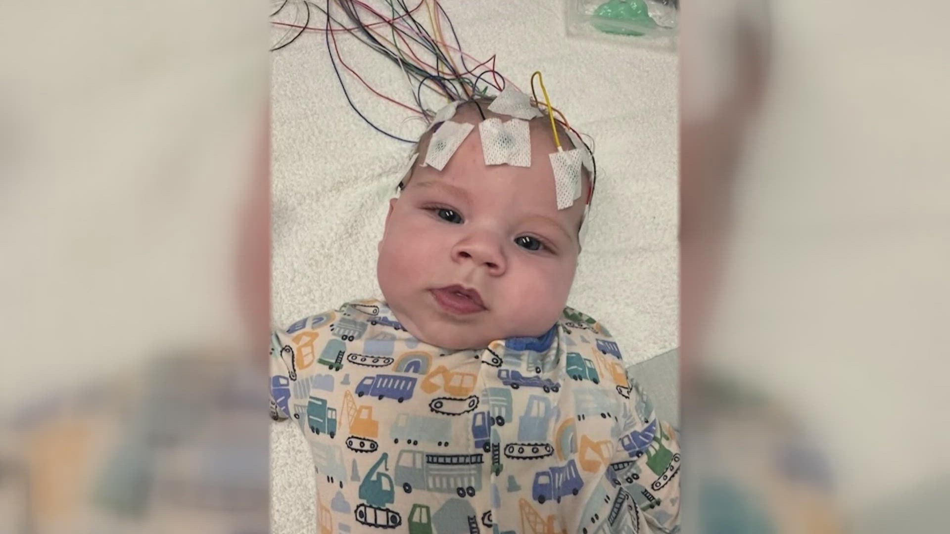 Baby Cam gets approval for critical brain surgery | 11alive.com