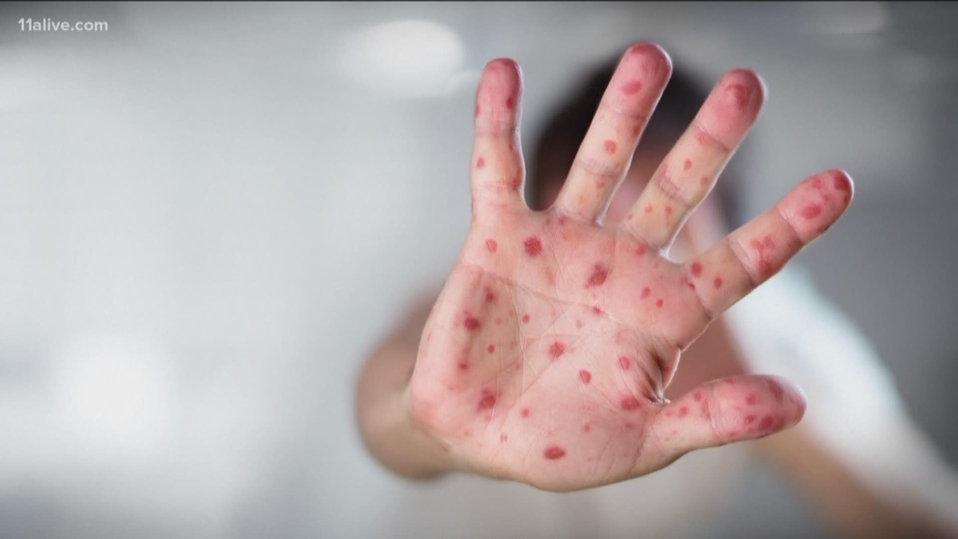The numbers show 101 cases of measles in 2019 so far.