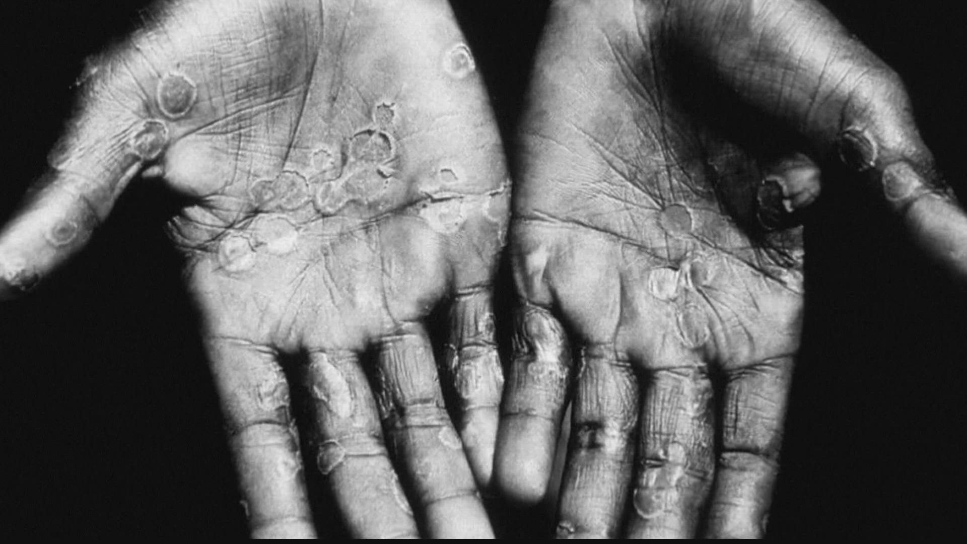 11Alive's medical expert Dr. Dujatha Reddy answers three of your questions about monkeypox.
