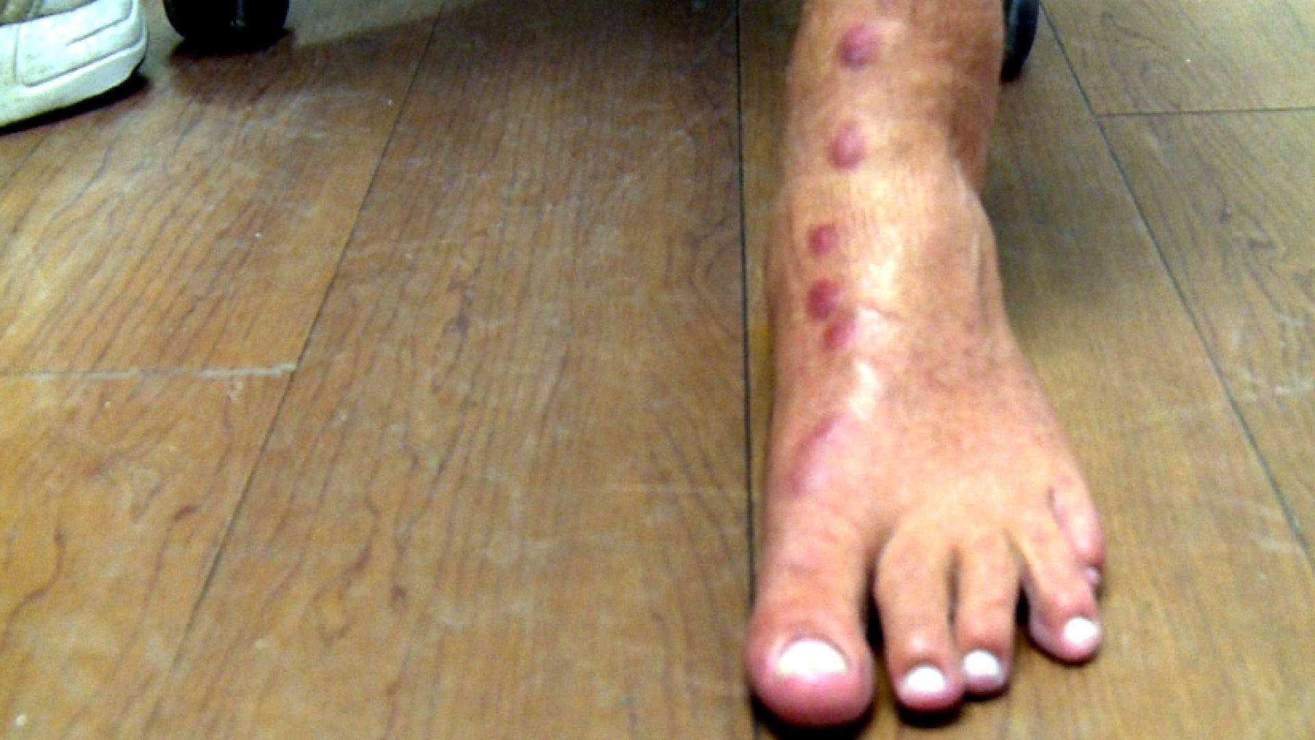 Seabather's eruption: Sea lice hits Gulf waters | 11alive.com