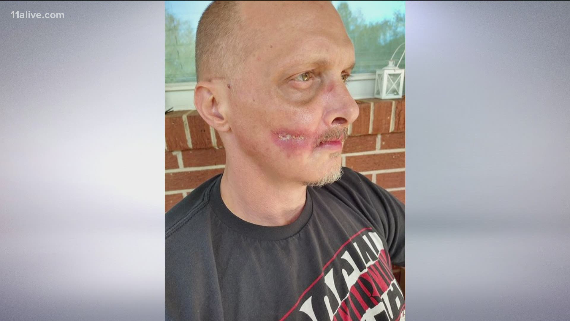 Road rage victim still healing months later, as medical expenses approach  $100K 