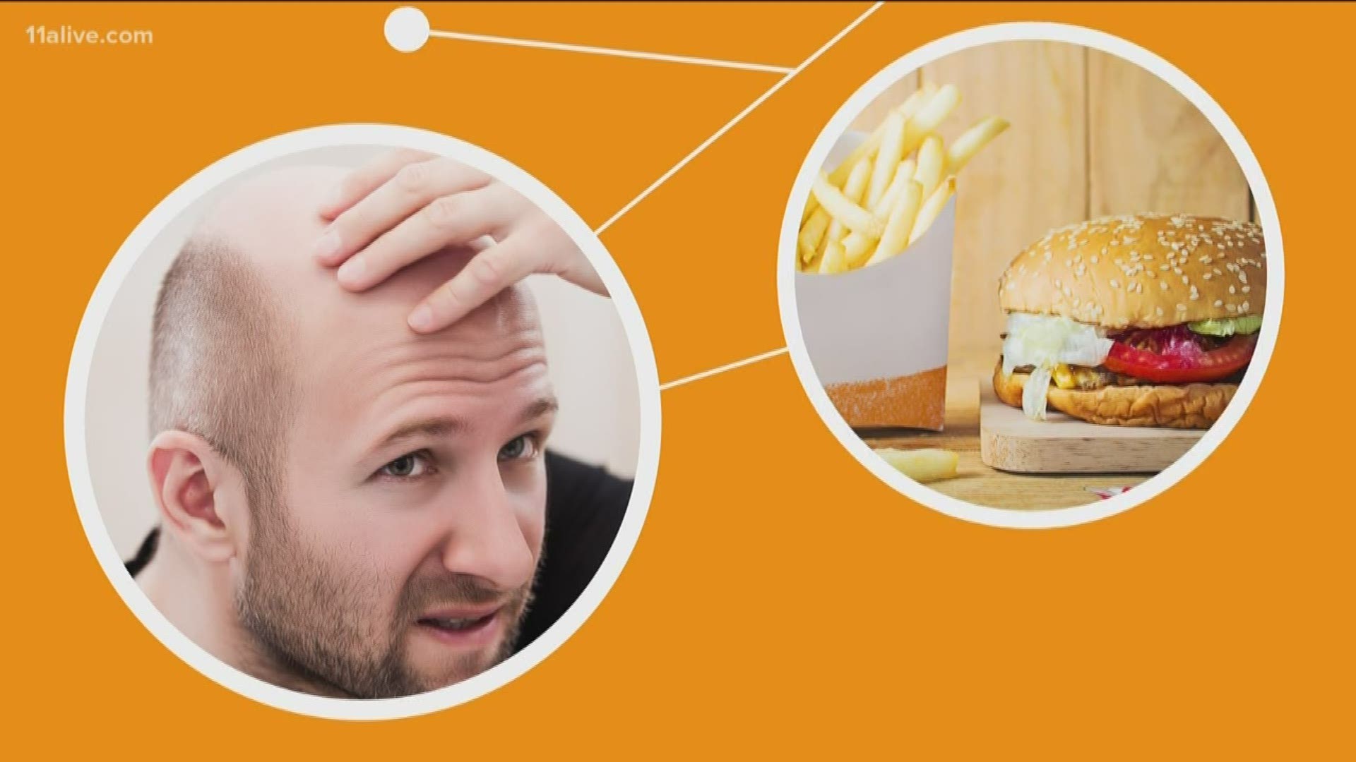 Fast food may add some inches around your waistline, but can it also cure baldness? Jerry Carnes connects the dots.