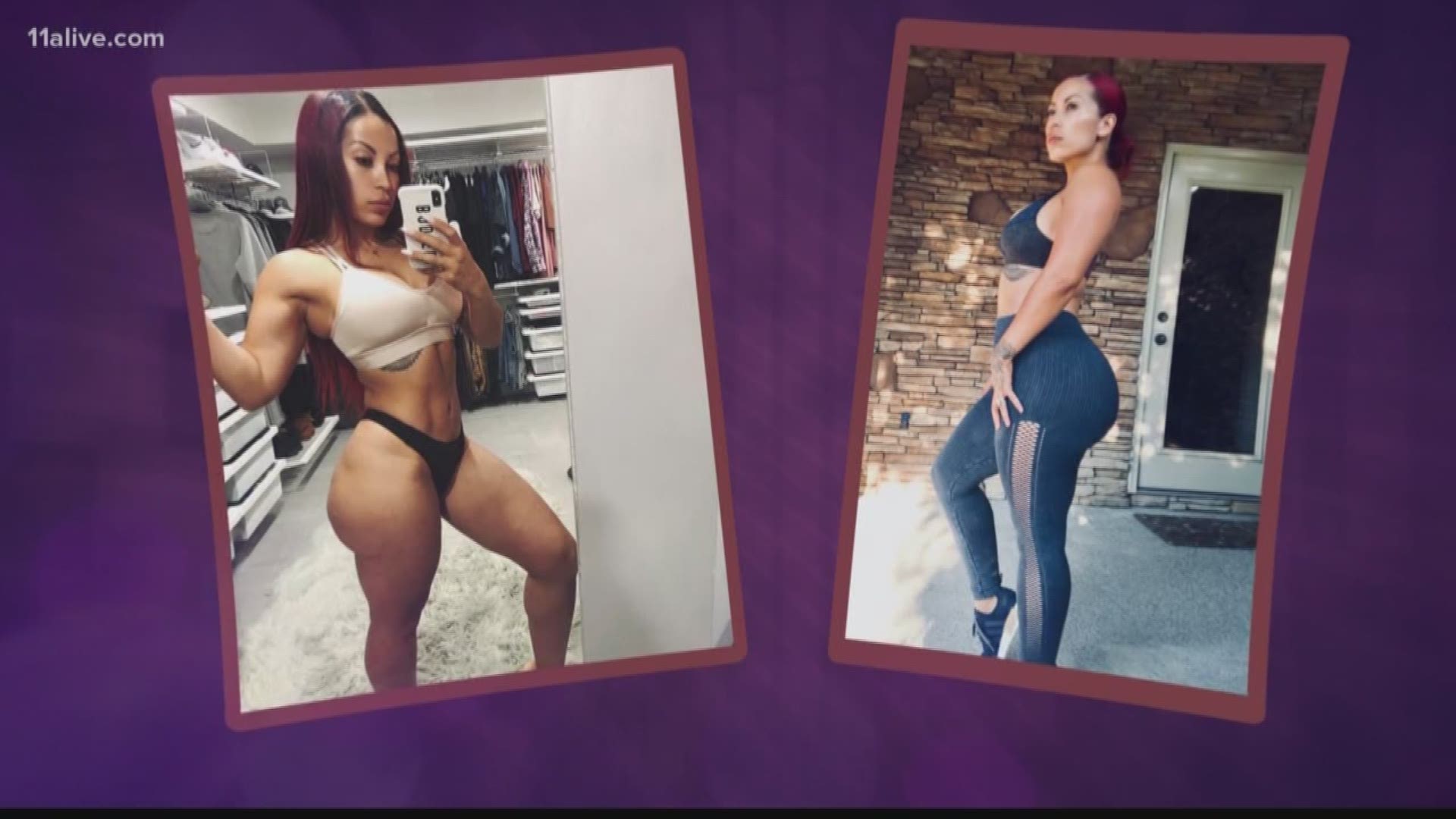 Brazilian Butt Lift (BBL) a Trend Killing Women, All You Need to