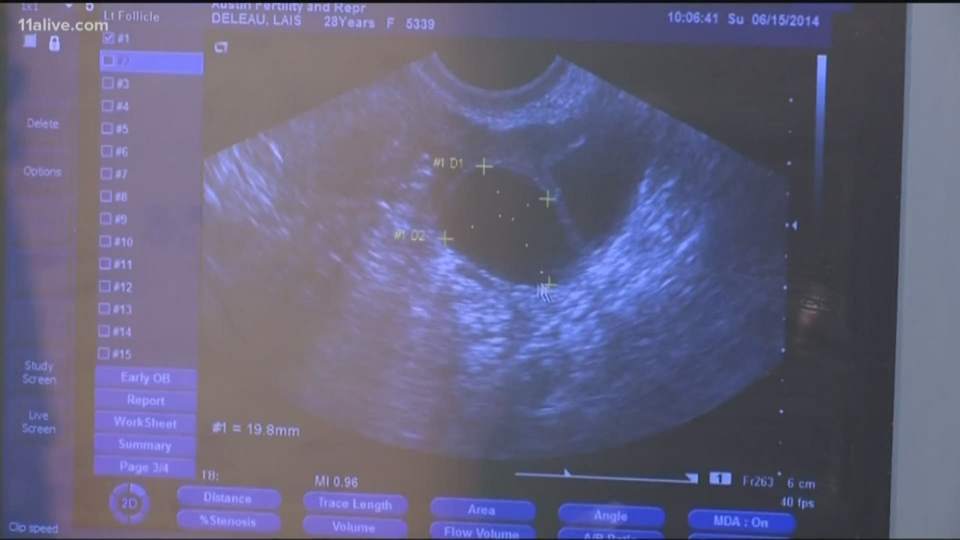 The bill makes it illegal to have an abortion after a fetal heartbeat is detected.