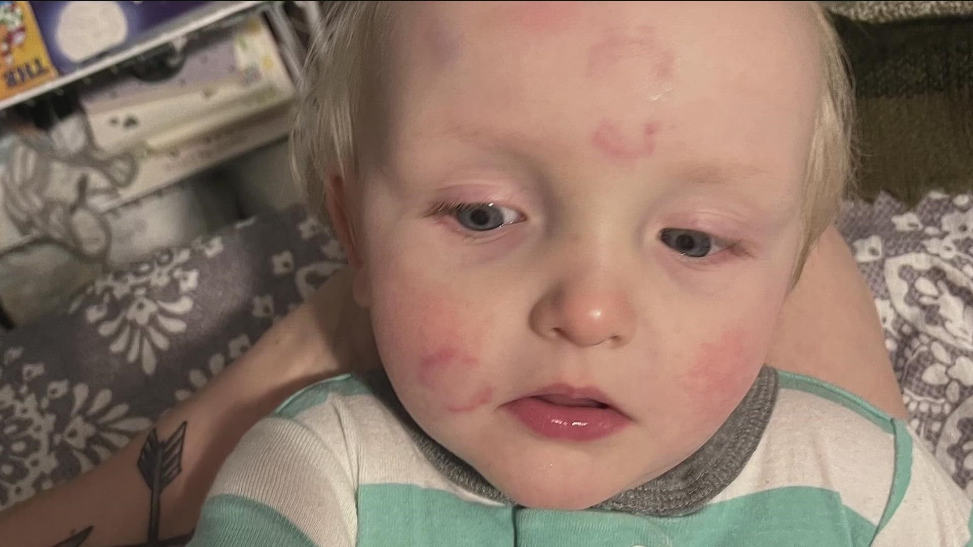 Daycare Under Investigation After Mom Picked Up Son Covered In Bites