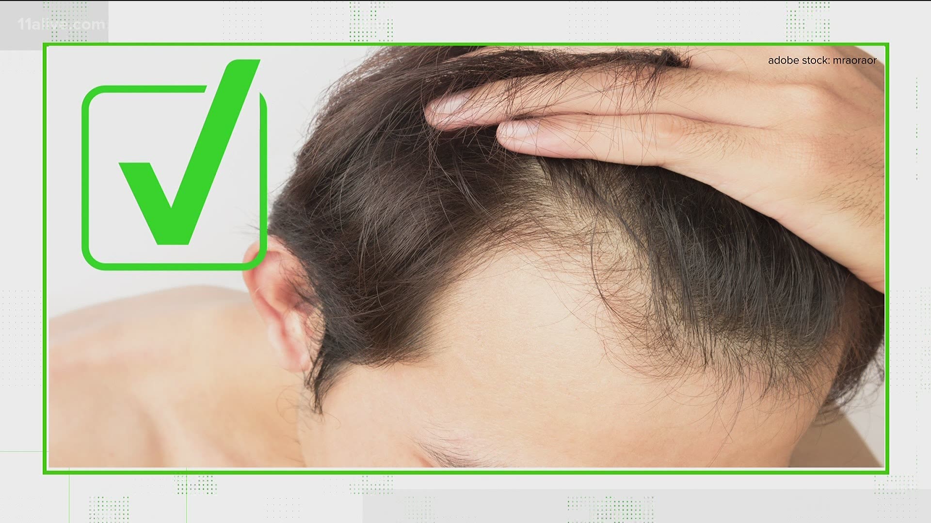 Medical experts and scientific studies say both men and women with a sign of increased androgens - which cause baldness - have an increased COVID-19 risk.