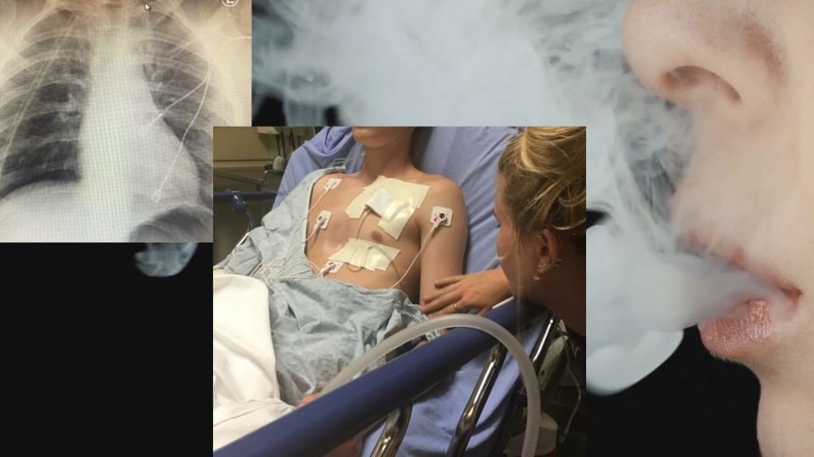 elfbar elfa master akku Georgia teenager hospitalized with collapsed lungs due to vaping
