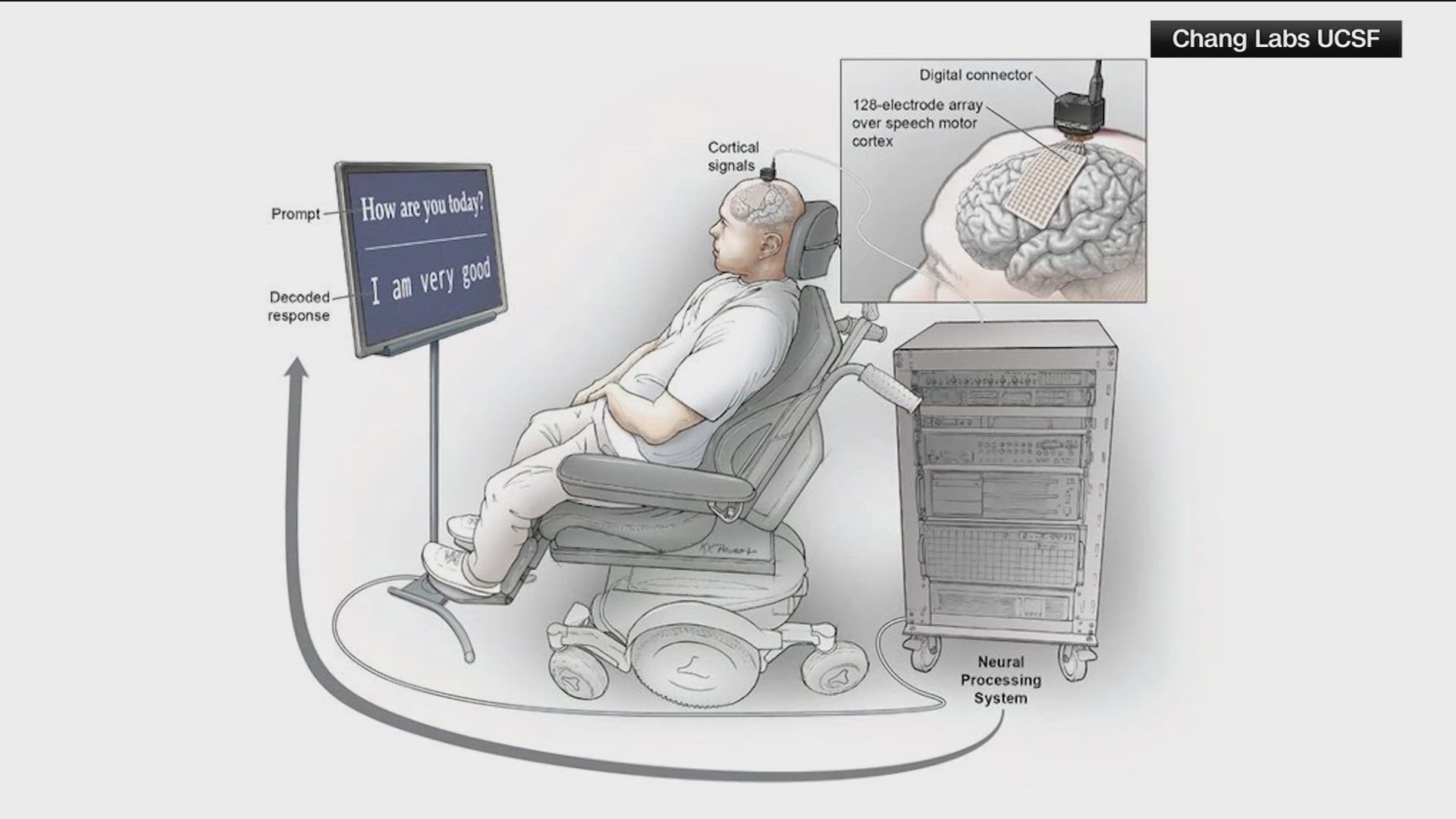 The implant, which uses artificial intelligence, helps the patient switch between communicating from English to Spanish.