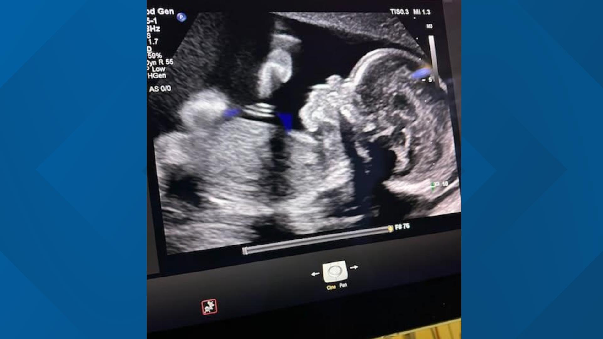 Family claims woman declared brain dead but pregnancy continues due to - Adriana Smith Pregnancy News: Is She Expecting?