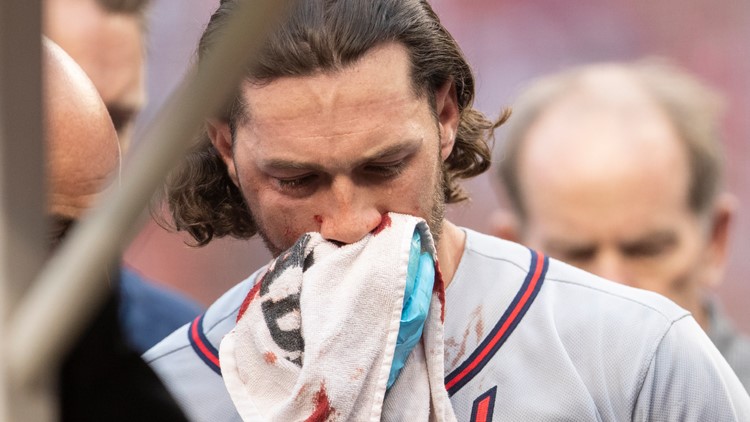 Charlie Culberson had gnarliest black eye after taking pitch to face