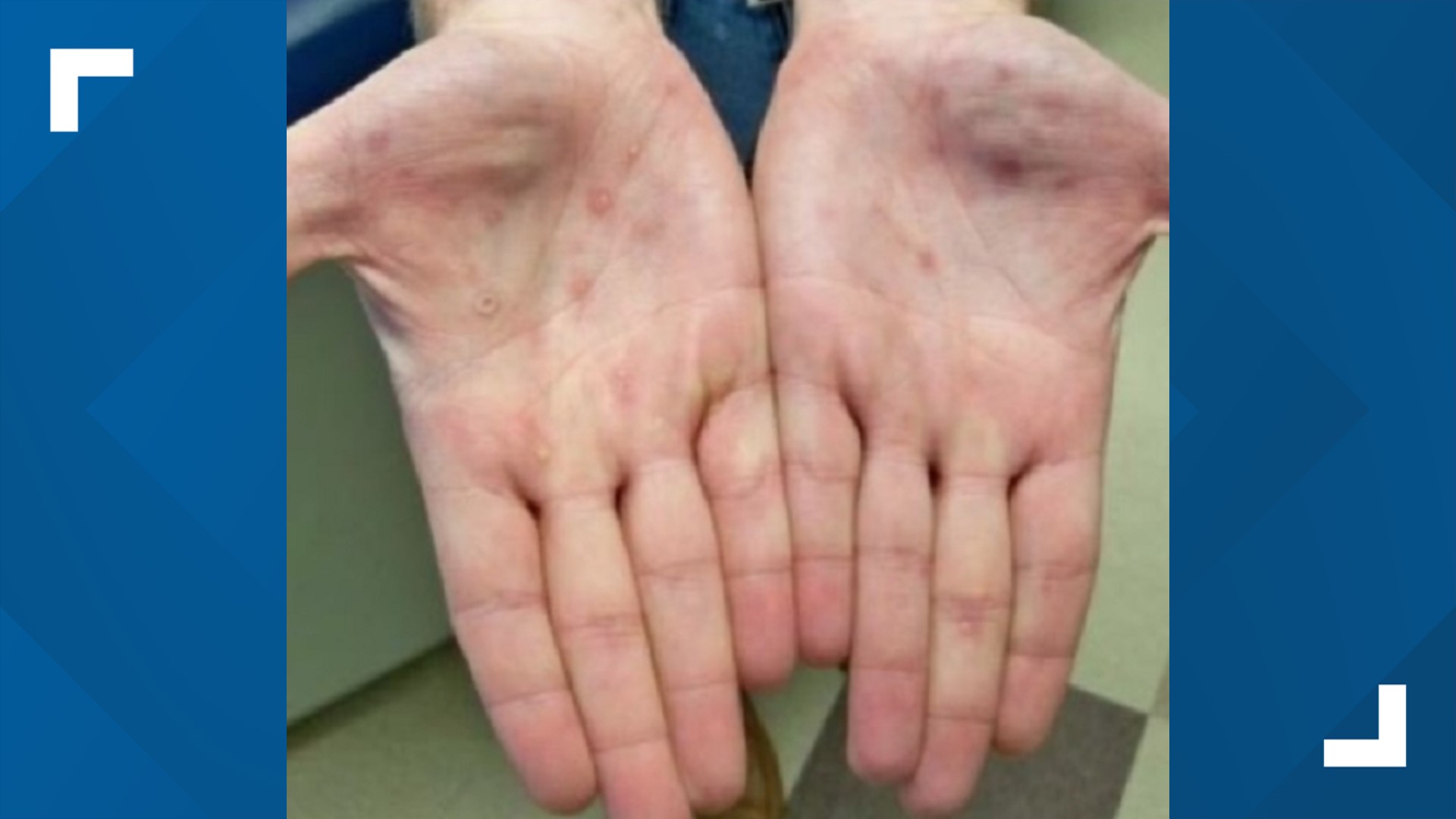 Casey Hampton first thought they were heat rashes, but a trip to his doctor and dermatologist told him otherwise: he had monkeypox.