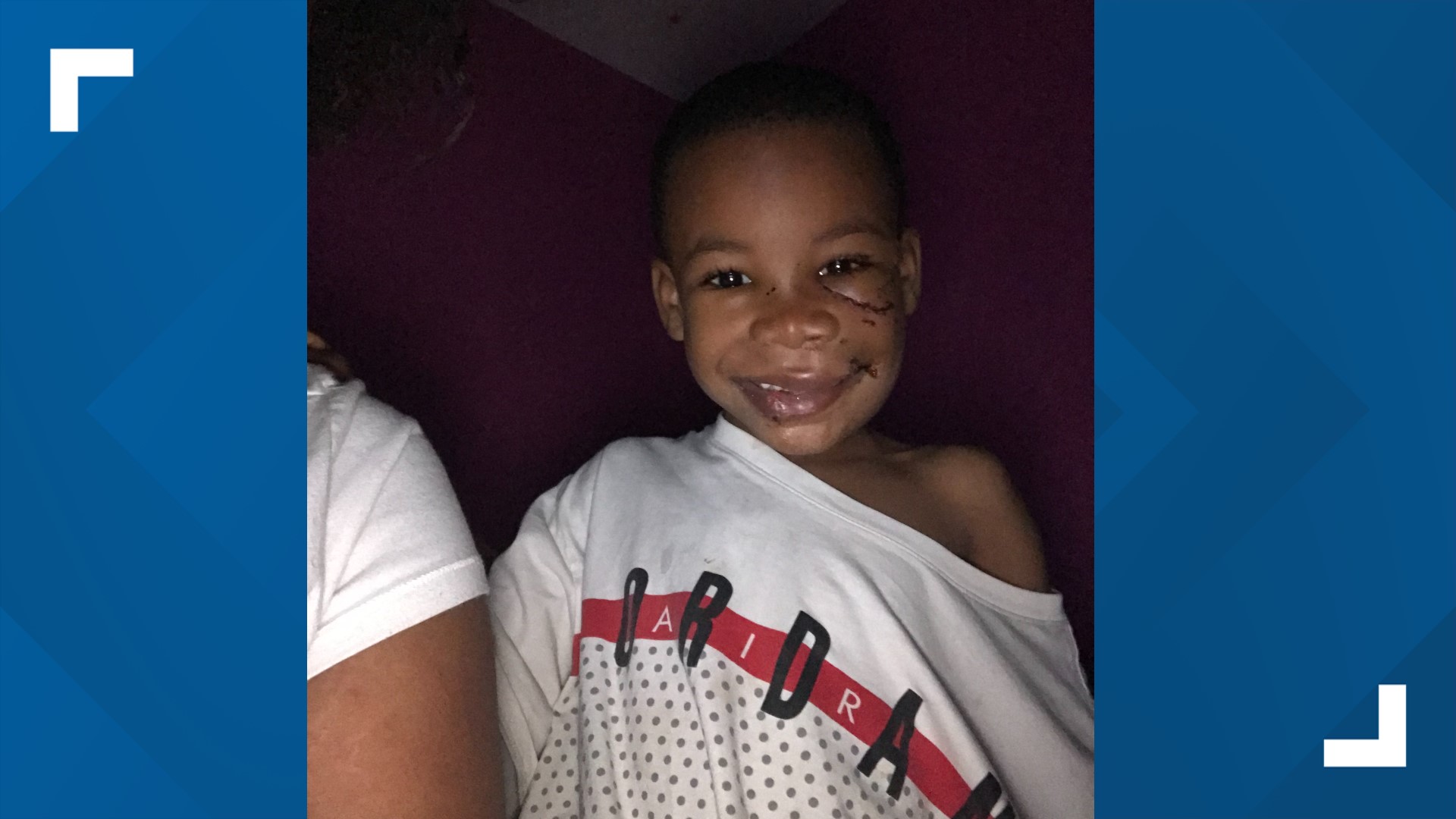 Atlanta Piedmont Park dog attack 6yearold boy hurt