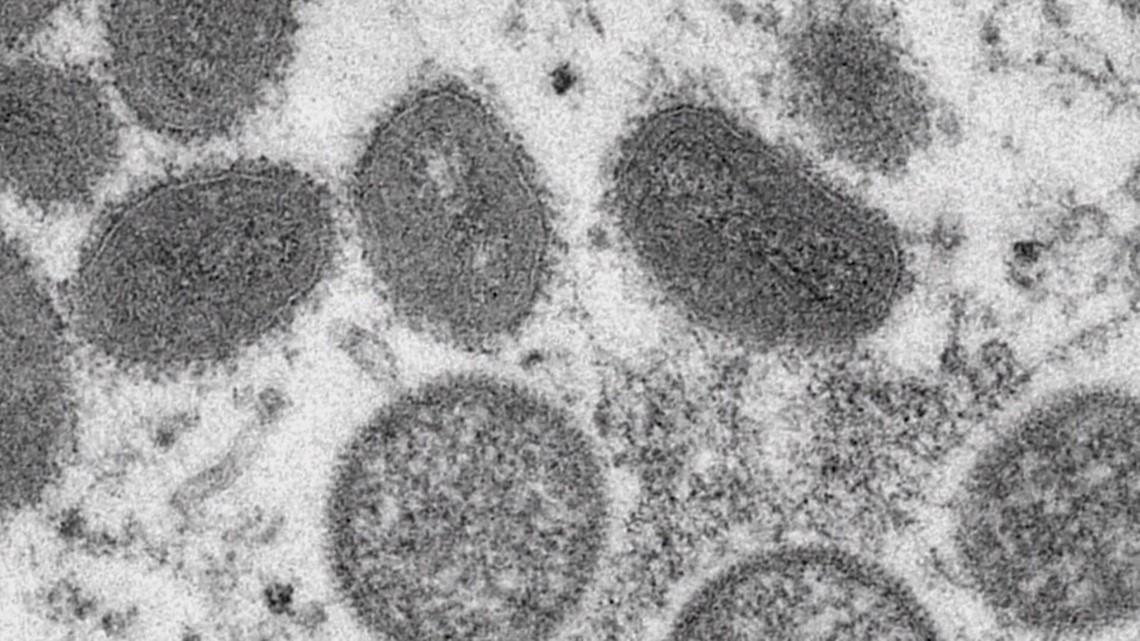 Georgia elementary school student positive for monkeypox - Vimarsana News