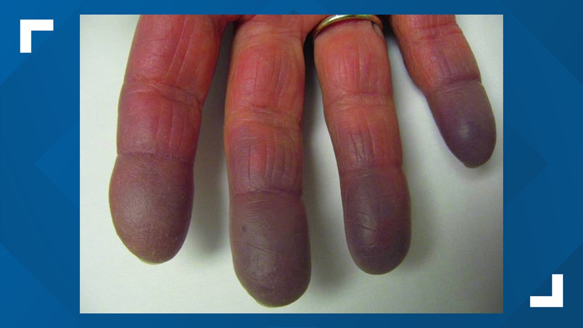 The classic bluish discoloration of the nail plate is seen on the right...  | Download Scientific Diagram