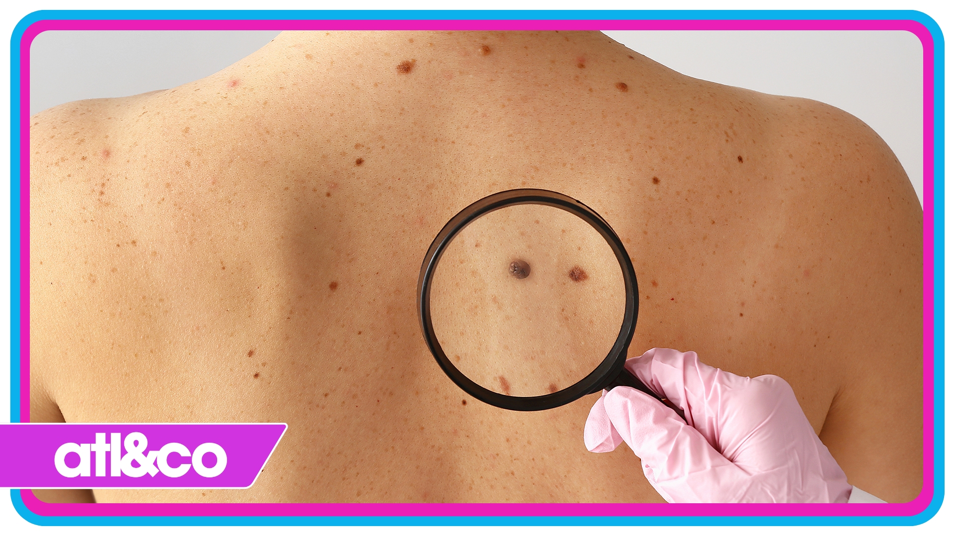 Learn about the signs to look for and how to prevent skin cancer.