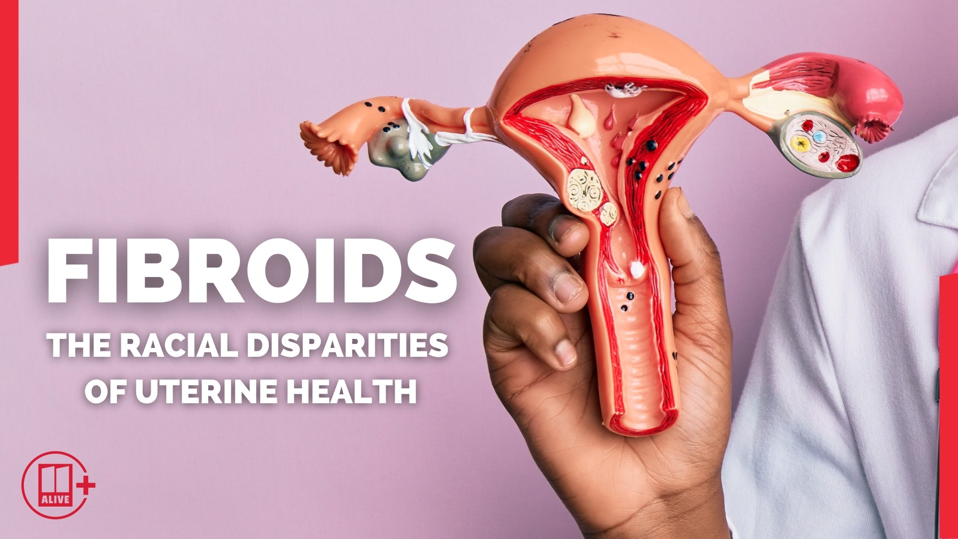 Fibroids are non-cancerous tumors that grow inside the uterus. Black women are 2-3 times more likely to suffer fibroids compared to white women.