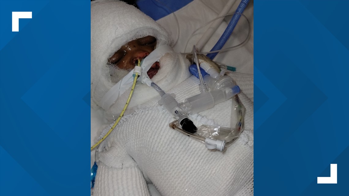 Amahd Black baby badly burned in freak accident