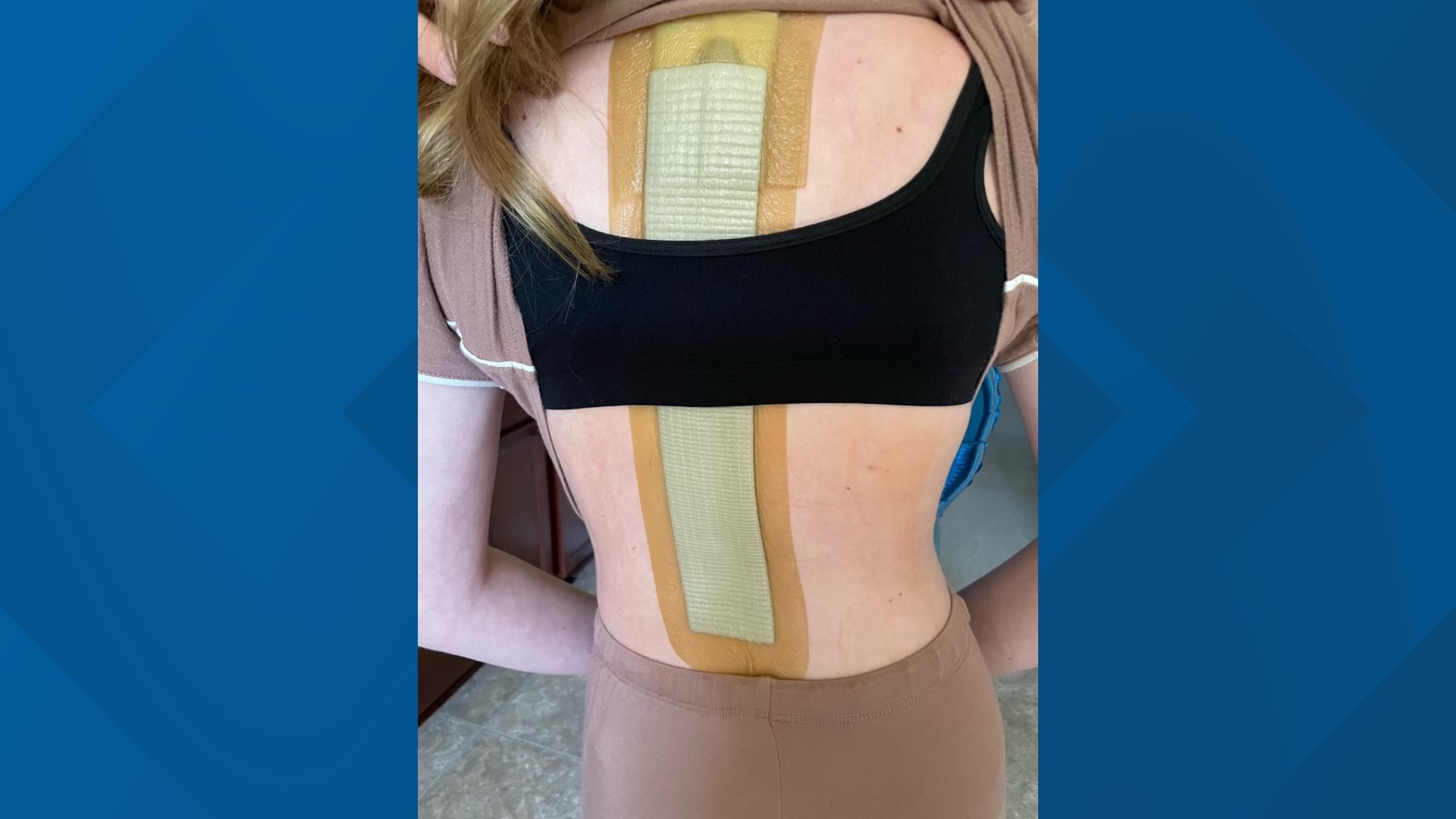 georgia-teen-has-spinal-fusion-surgery-after-scoliosis-diagnosis