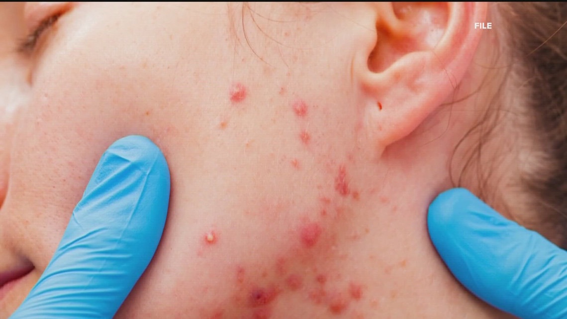 3 new cases of measles confirmed in Georgia, according to state health department